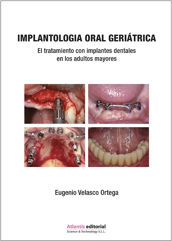 Implantología Oral Geriátrica.