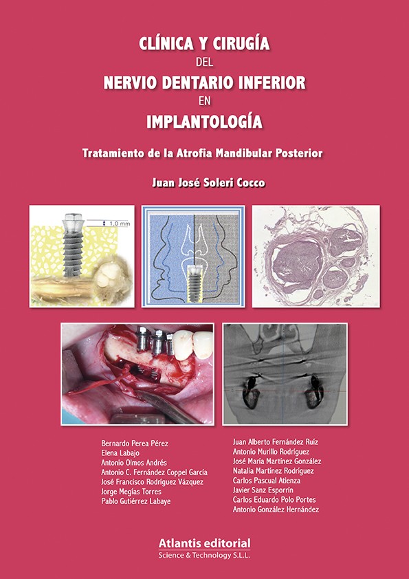 Clínica y Cirugía del Nervio Dentario Inferior en Implantología.