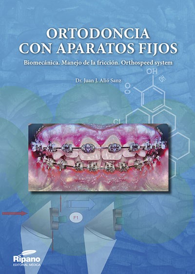 Ortodoncia con Aparatos Fijos. Biomecánica.